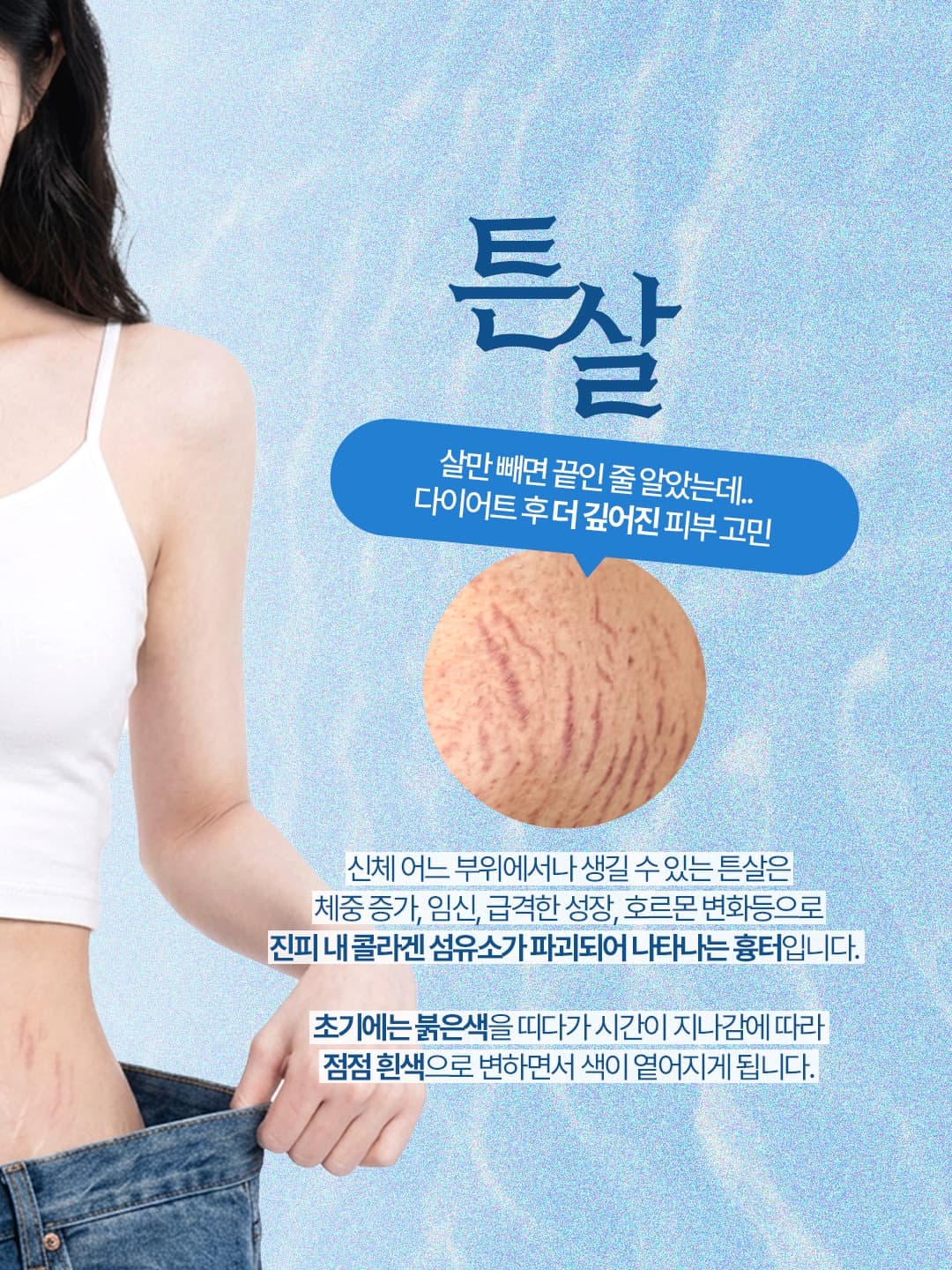 튼살은 단순 주름이 아니라