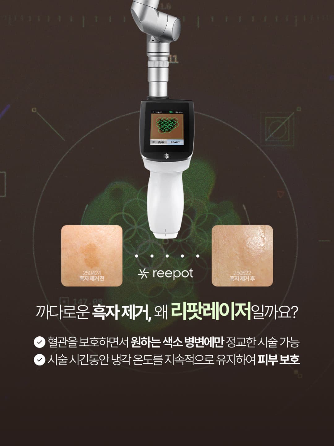 💡 Why is 'Reepot Laser' the choice for dark spot removal?
