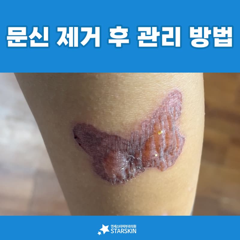 흉터로 이어지는 네 가지 상황과 그 앞에서 할 일