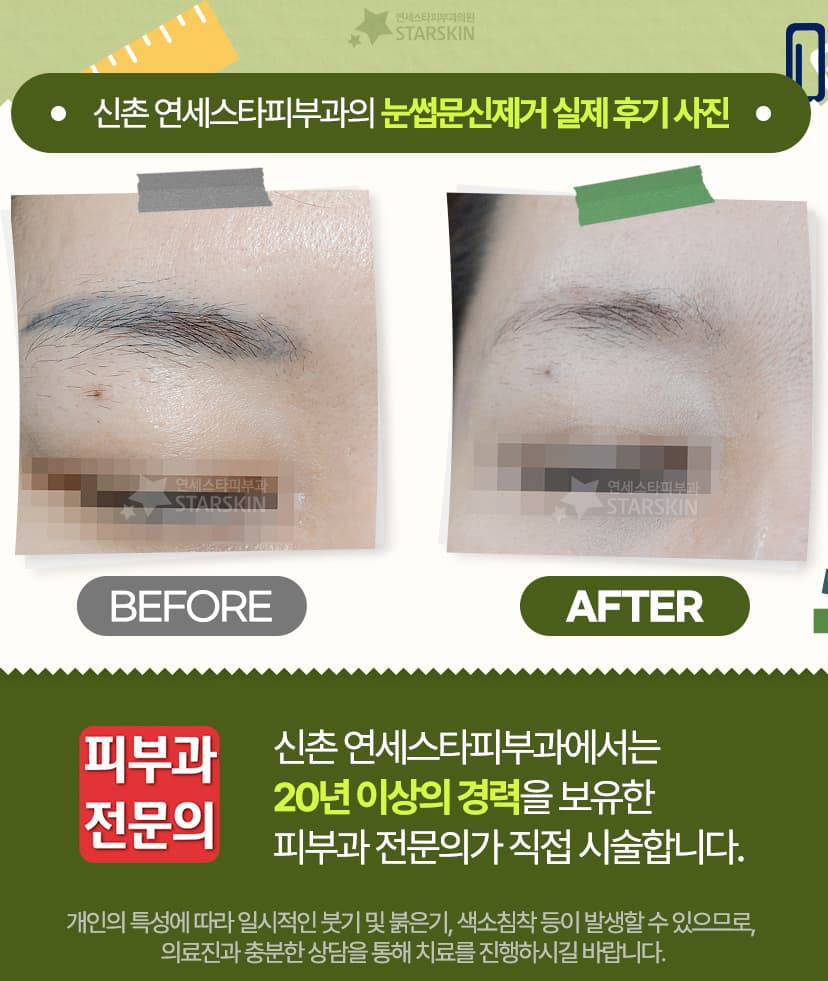 검게 보이던 눈썹 반영구가 여러 파장을 필요로 하는 이유