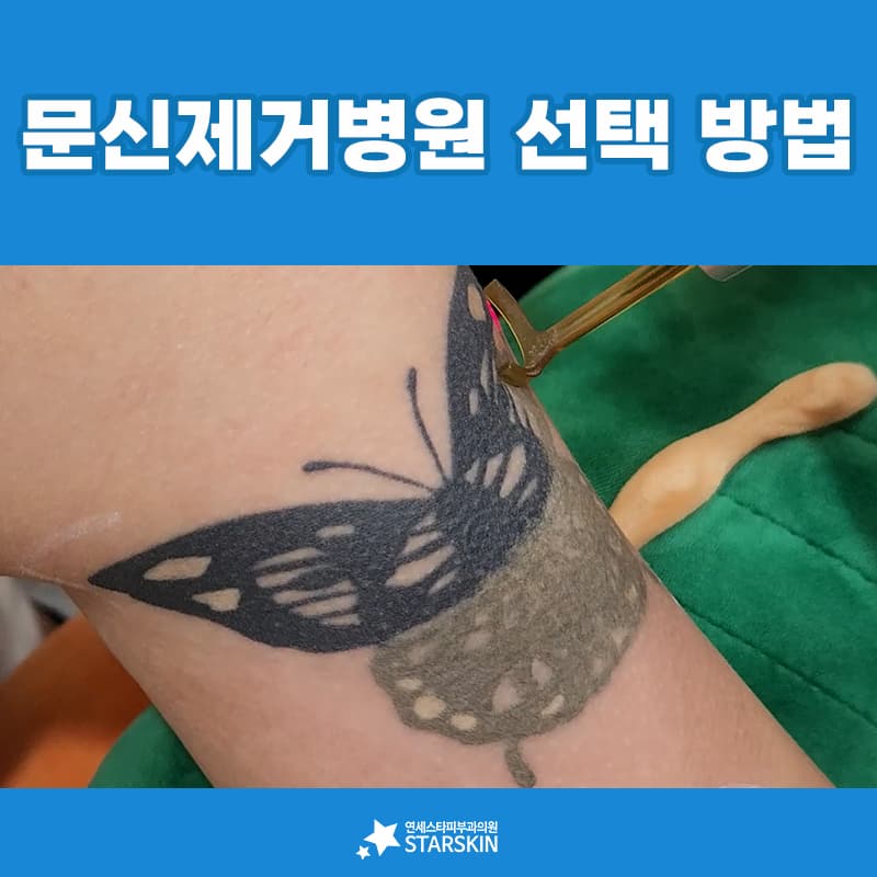 가격표보다 먼저 확인해야 할 문신제거 병원의 조건