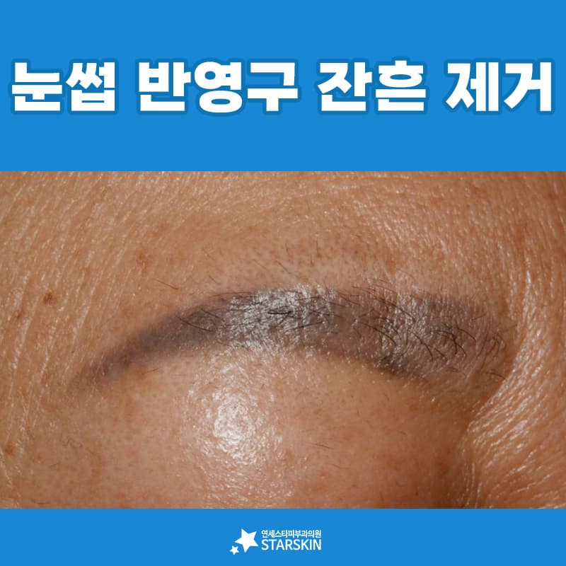 새 눈썹을 그리기 전에 남은 잔흔부터 정리합니다