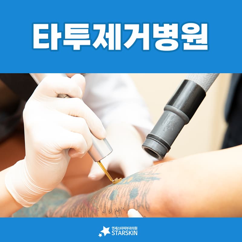 펄스폭이 짧아지면서 문신제거 주기가 한 달로 좁혀졌습니다