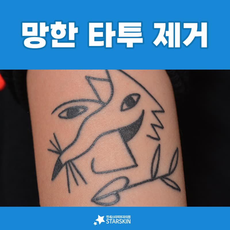 문신을 지우는 세 가지 방법을 나란히 놓고 보면