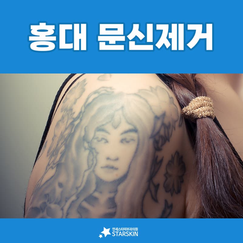 새긴 지 얼마 안 된 문신에는 짧은 기회의 창이 있습니다