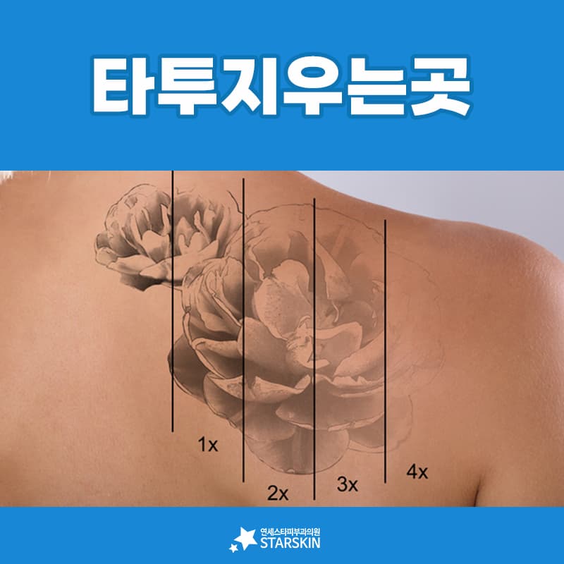 타투 지우는 곳을 고를 때 가격보다 먼저 보는 것