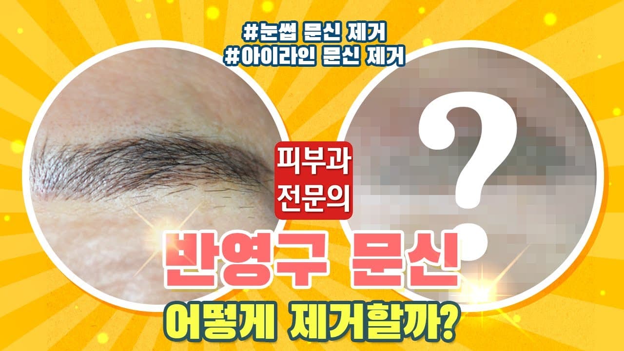 반영구 잔흔 제거 레이저를 고를 때 보는 세 가지