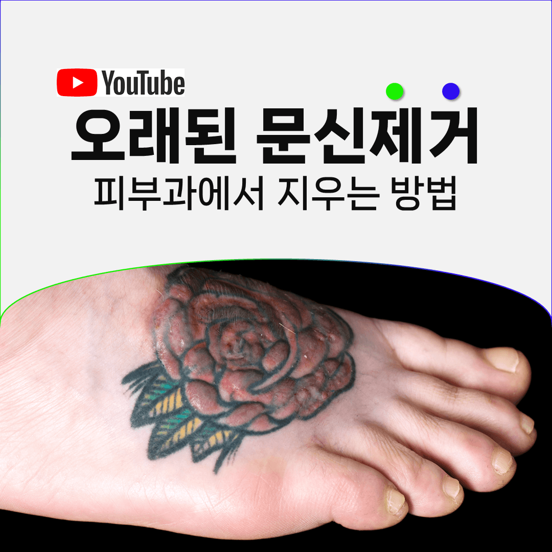 오래된 문신이 오히려 지우기 수월한 경우가 있습니다