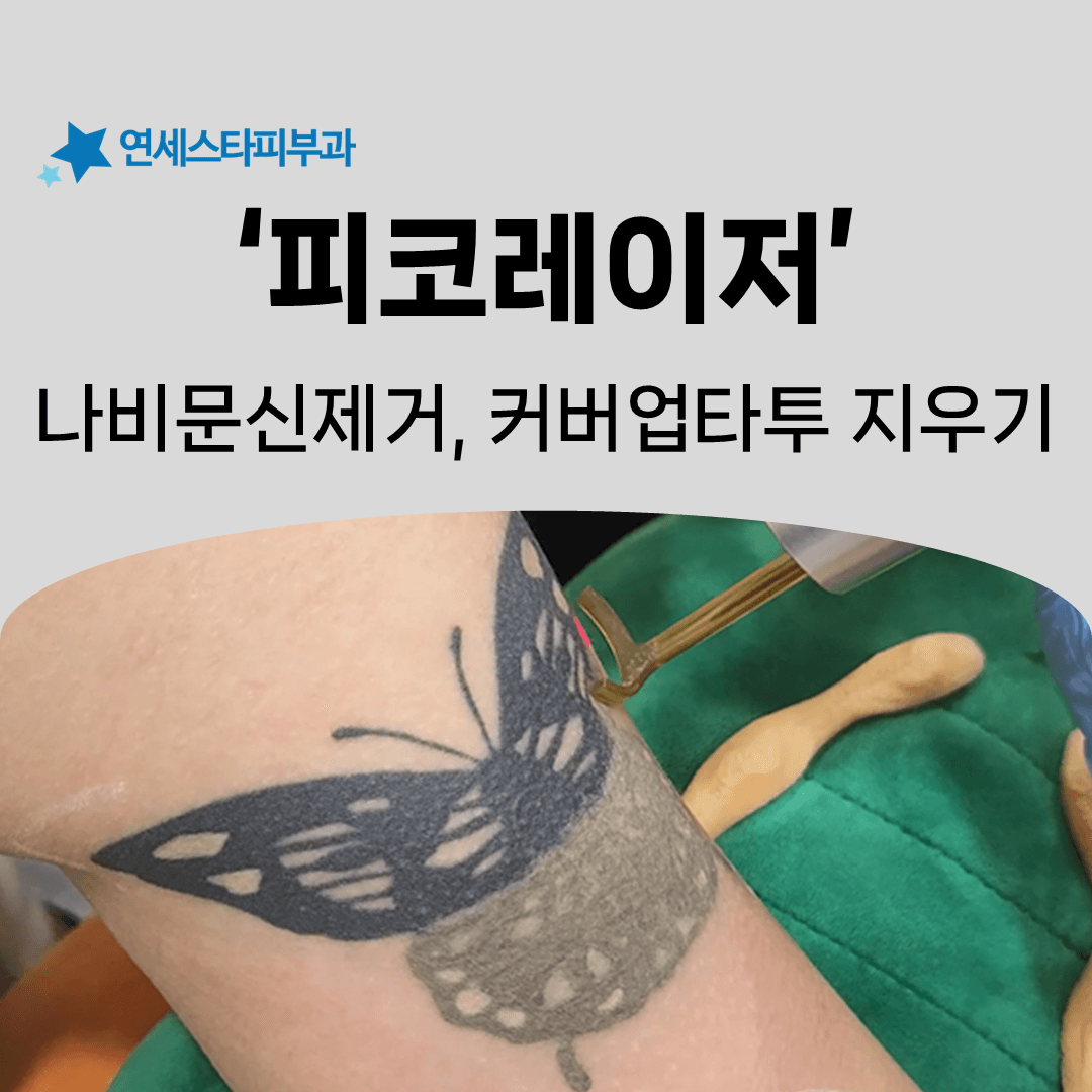 커버업으로 덮은 나비 문신을 지우는 순서