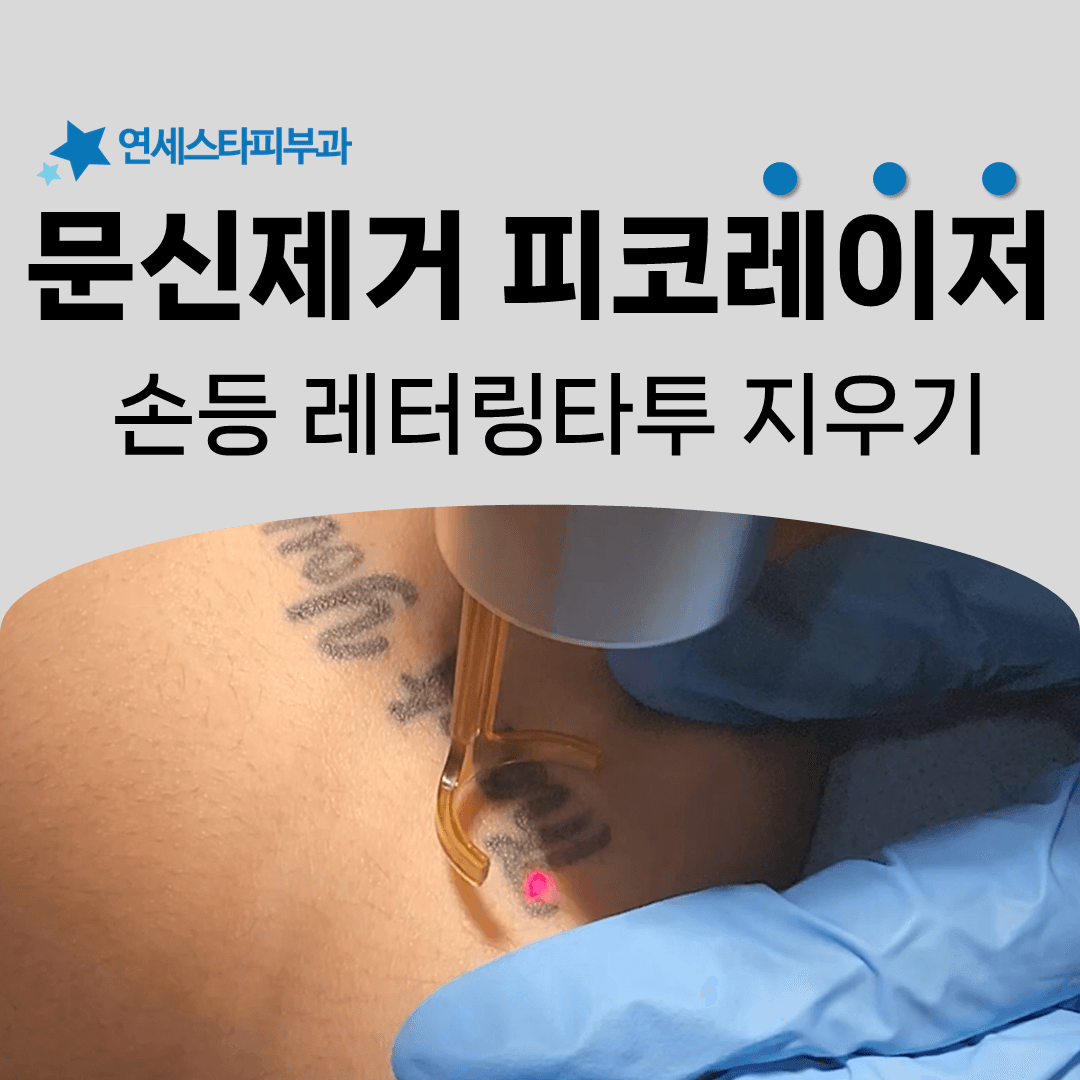 손등 레터링 타투를 지우는 한 번의 시술 안에서
