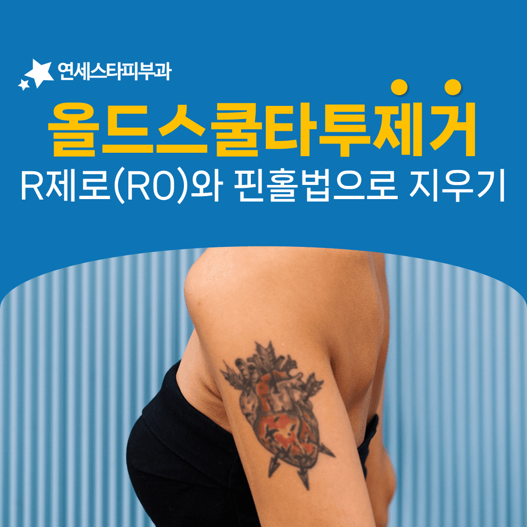 굵은 외곽선과 원색이 겹친 올드스쿨 타투를 지울 때
