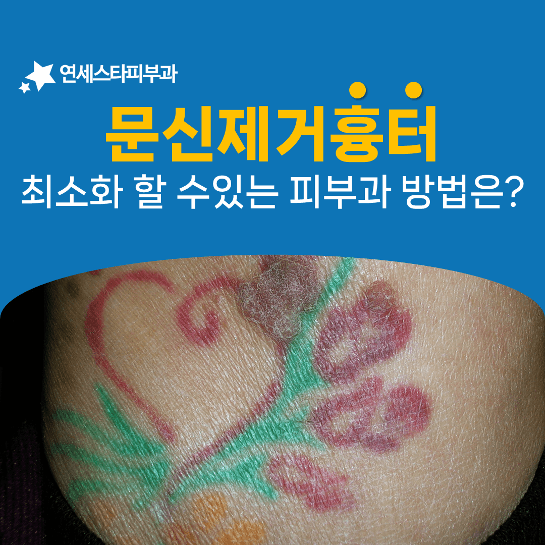 문신제거 흉터가 생기는 네 가지 상황