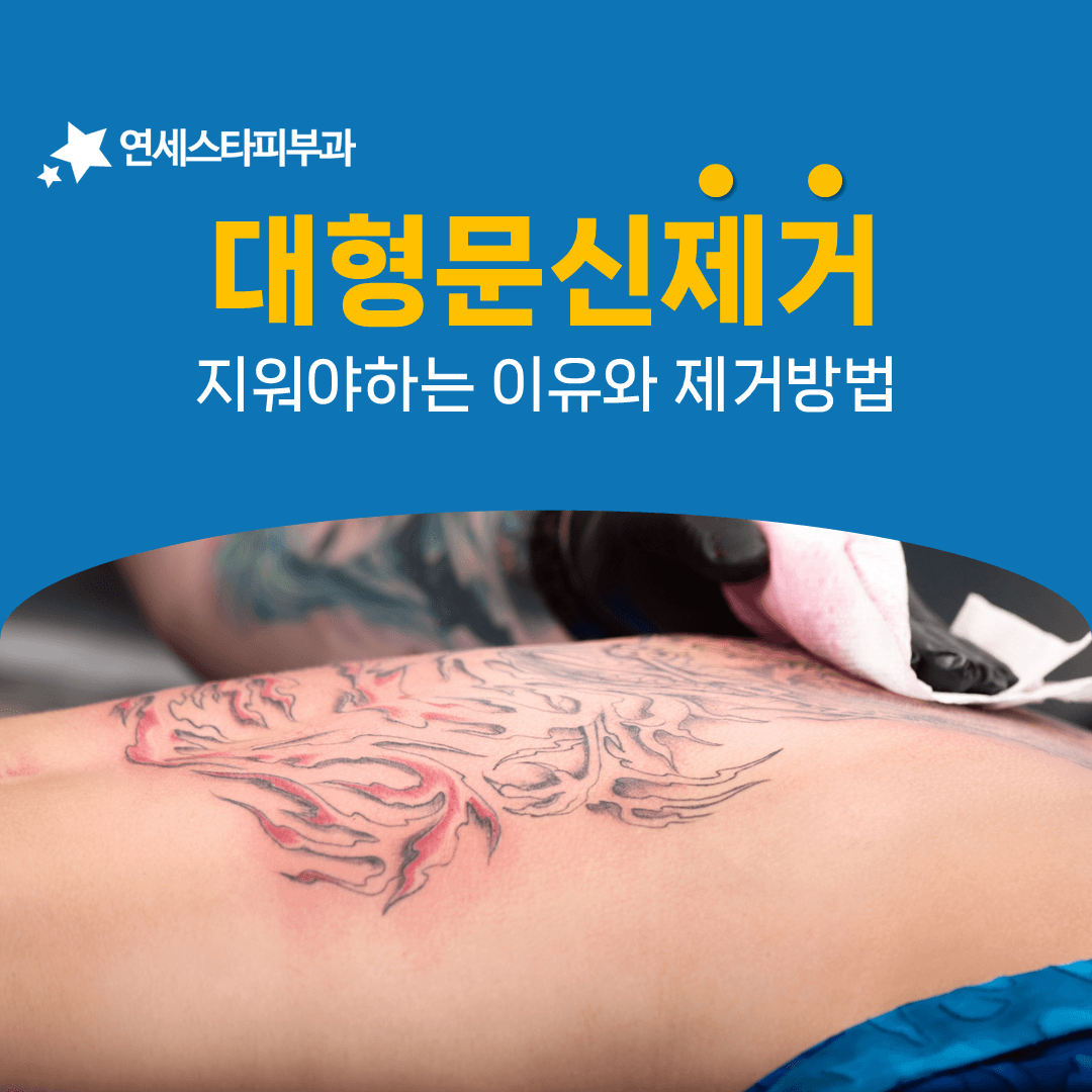 넓은 문신을 구역으로 나눠 지워 나가는 과정