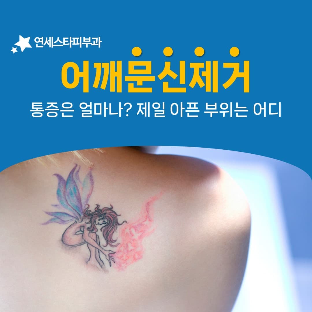 부위별 문신제거 통증 차이와 어깨의 위치