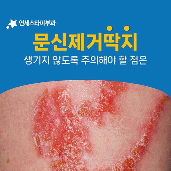 레이저 뒤에 앉는 딱지를 흉터로 남기지 않으려면