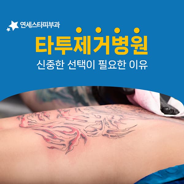 오래된 타투가 오히려 지우기 수월한 이유