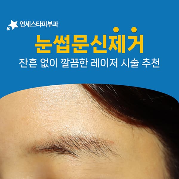 눈썹 문신을 지운 뒤 눈썹은 다시 자랄까