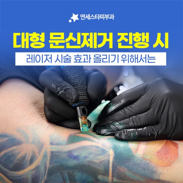 대형문신 제거는 출력보다 계획에서 갈립니다