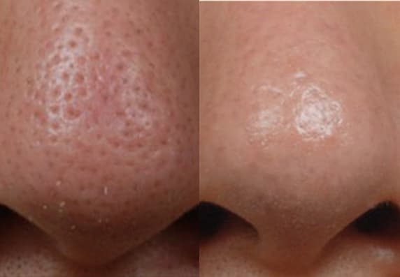 Pigmentation & Pores