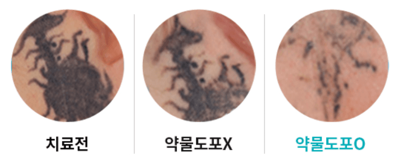 Tattoo Removal