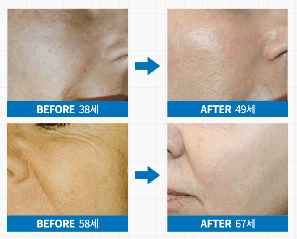 Lifting & Anti-aging