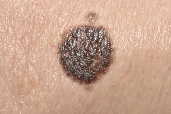 Bokuen News Lentigo Age Spots Repat Laser Simple Solution