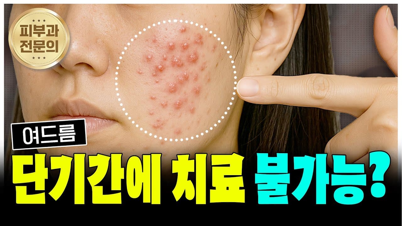 Clear Acne in Days? Never Fall for It, Dermatologist Warns