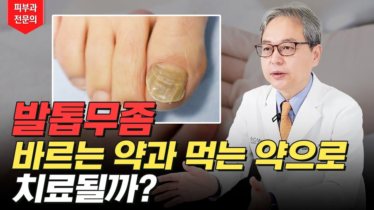 灰指甲,口服药或外用药能治好多少?