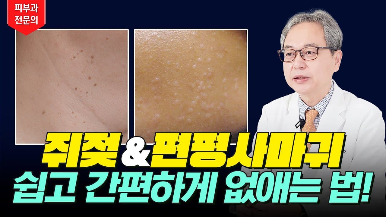 쥐젖 & 편평사마귀 말끔히 없애는 쉽고 간편한 방법 ✨ 쥐젖 편평사마귀 원인