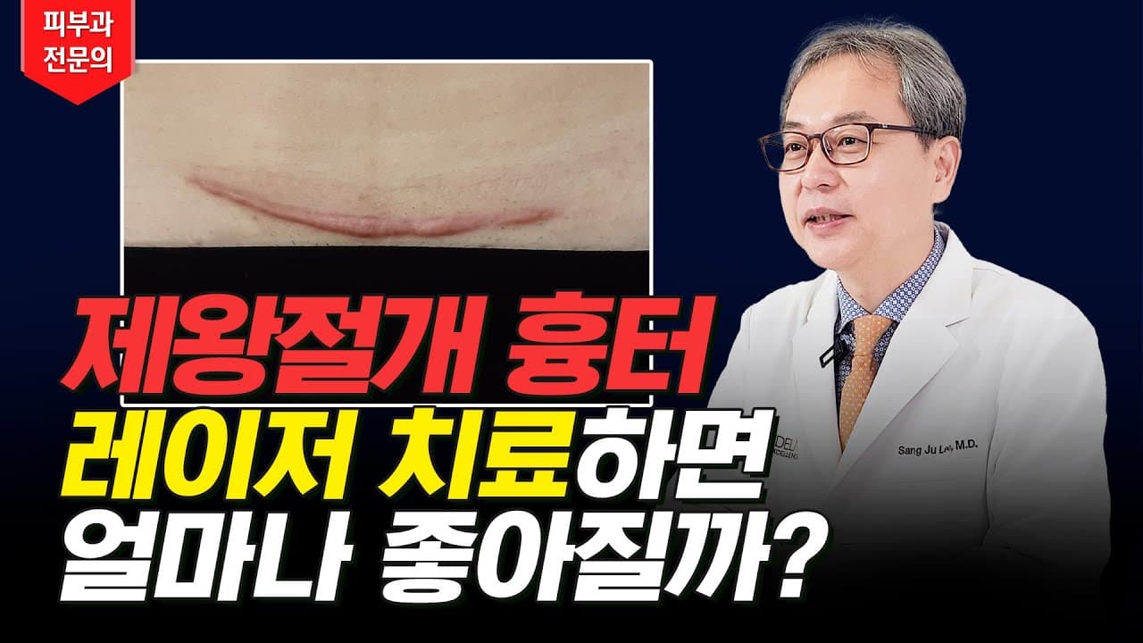 C-Section Scar Removal: How A Dermatologist Effectively Treats It