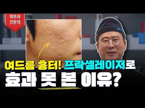 여드름흉터 프락셀레이저로 효과가 없는 이유!? (feat 프락셀 레이저, 서브시전)