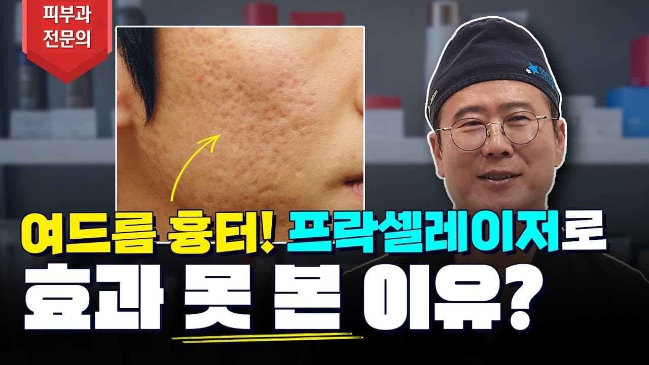Acne Scars And Fraxel Laser: Why It Doesn't Work, Plus Subcision