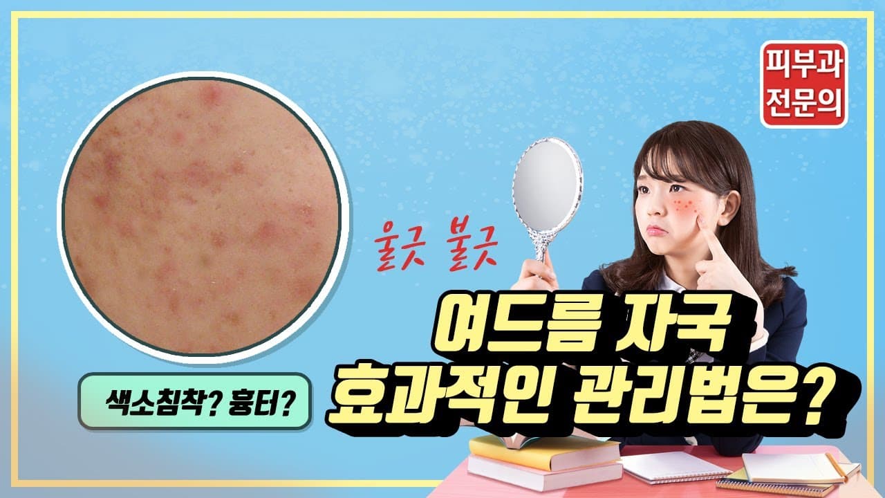 여드름자국을 지우는 방법! 피부과 전문의가 알려드립니다.(여드름흔적,색소침착,초기흉터)