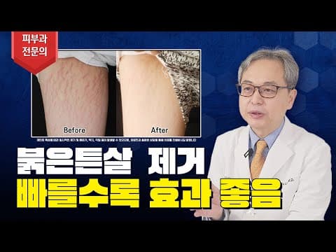 붉은 튼살 레이저 치료하면 100% 제거되나요? 🤔
