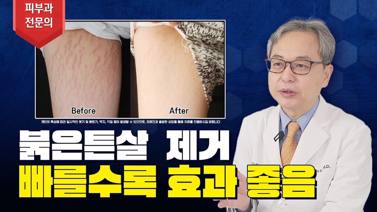 Red Stretch Mark Laser Does It Remove Completely