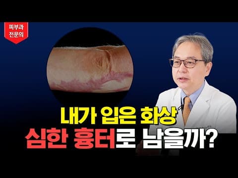 화상 입었을 때 필수 시청 🚨 화상흉터 잘 남는 화상 케이스 알려드립니다 ✅