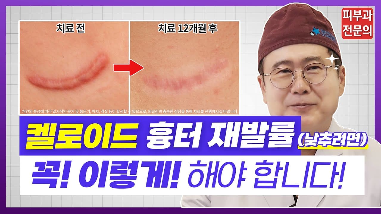 켈로이드 흉터 재발 하지 않도록 치료하는 법 👨🏻🔬 피부과 전문의가 속 시원히 알려드리겠습니다!