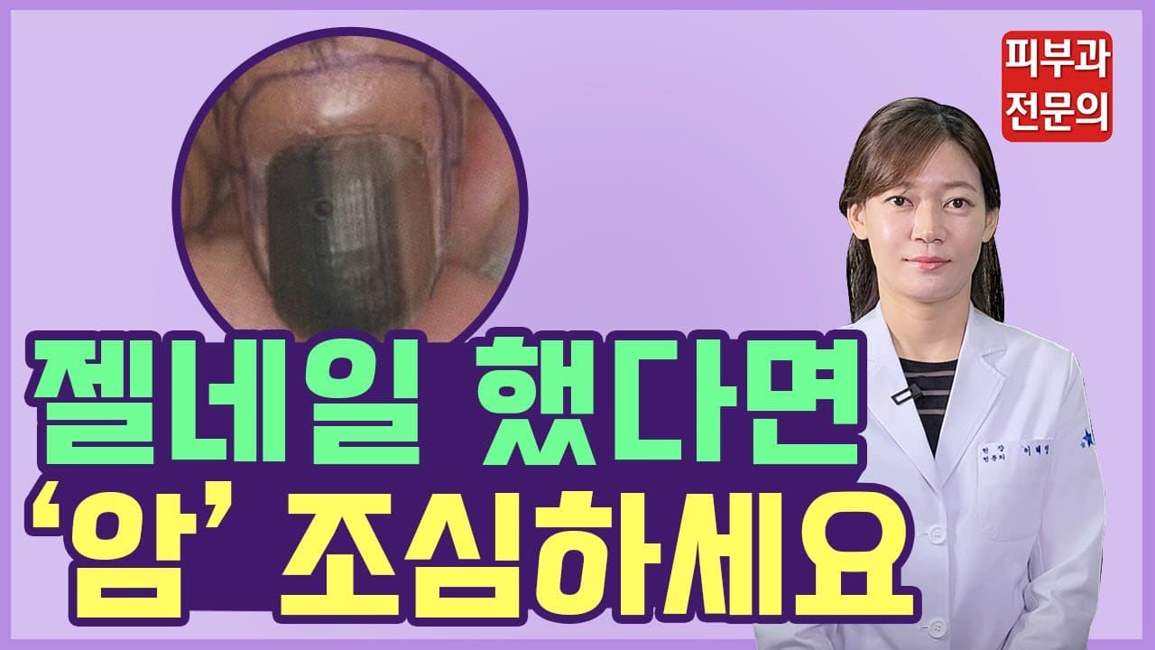 做了美甲・足部护理・甲油胶贴纸要小心这种疾病!(指甲黑线、脚趾甲黑线)