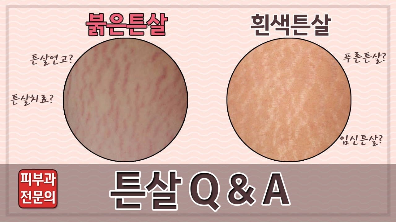 피부과 전문의가 알려주는 튼살에 대한 궁금증(튼살Q&A)