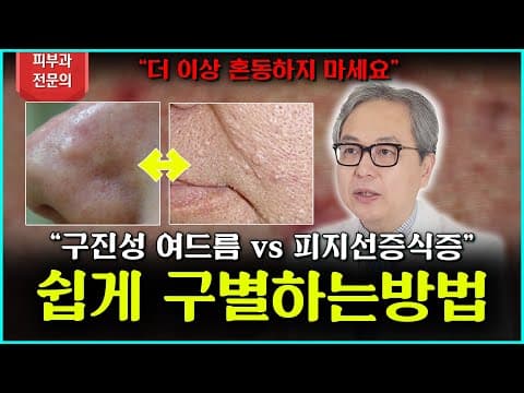 구진성 여드름 흉터 vs 피지선 증식증! 차이를 쉽게 구별하는 방법
