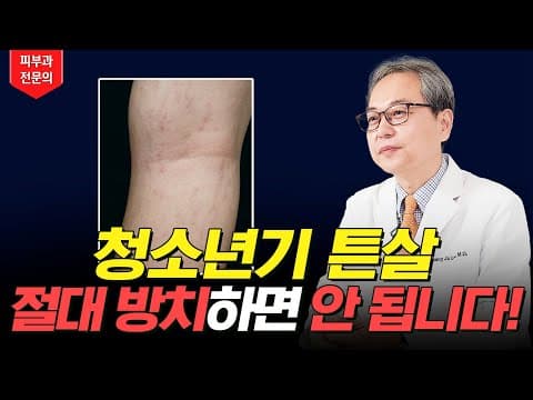 청소년 튼살 지금 바로 치료해야 하는 이유 ☝🏻 튼살 크림 레이저 추천