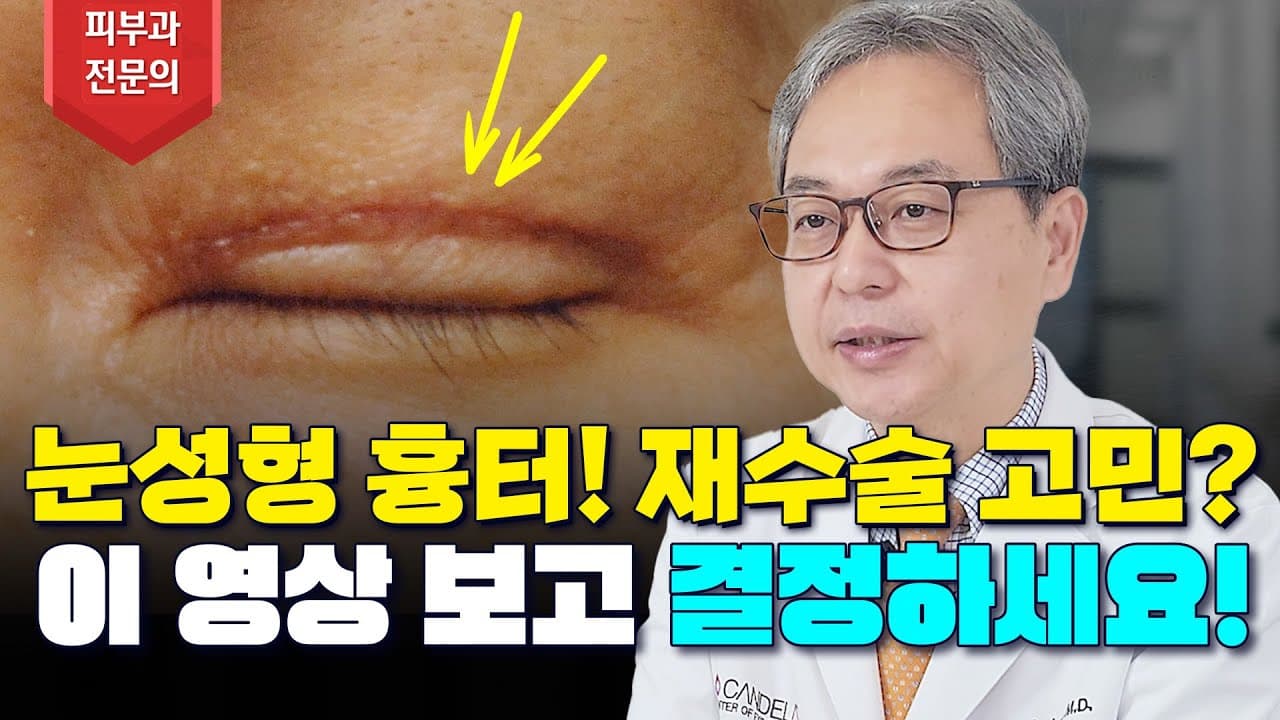 앞트임 쌍꺼풀 등 눈 성형 흉터 👀 레이저 제거 vs 재수술 🤔 고민된다면 필수시청❗❗