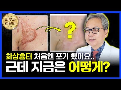 화상 흉터? 치료는 못 한다고요? 지금은 어떨까요?