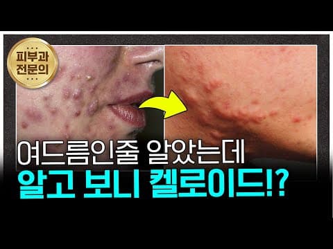 여드름인 줄 알았는데… 알고 보니 ‘켈로이드’였습니다