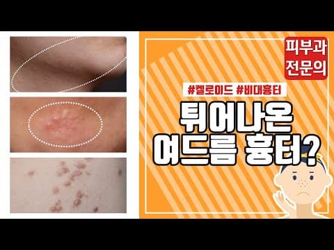 여드름이 아니라 '여드름 흉터'라고요?