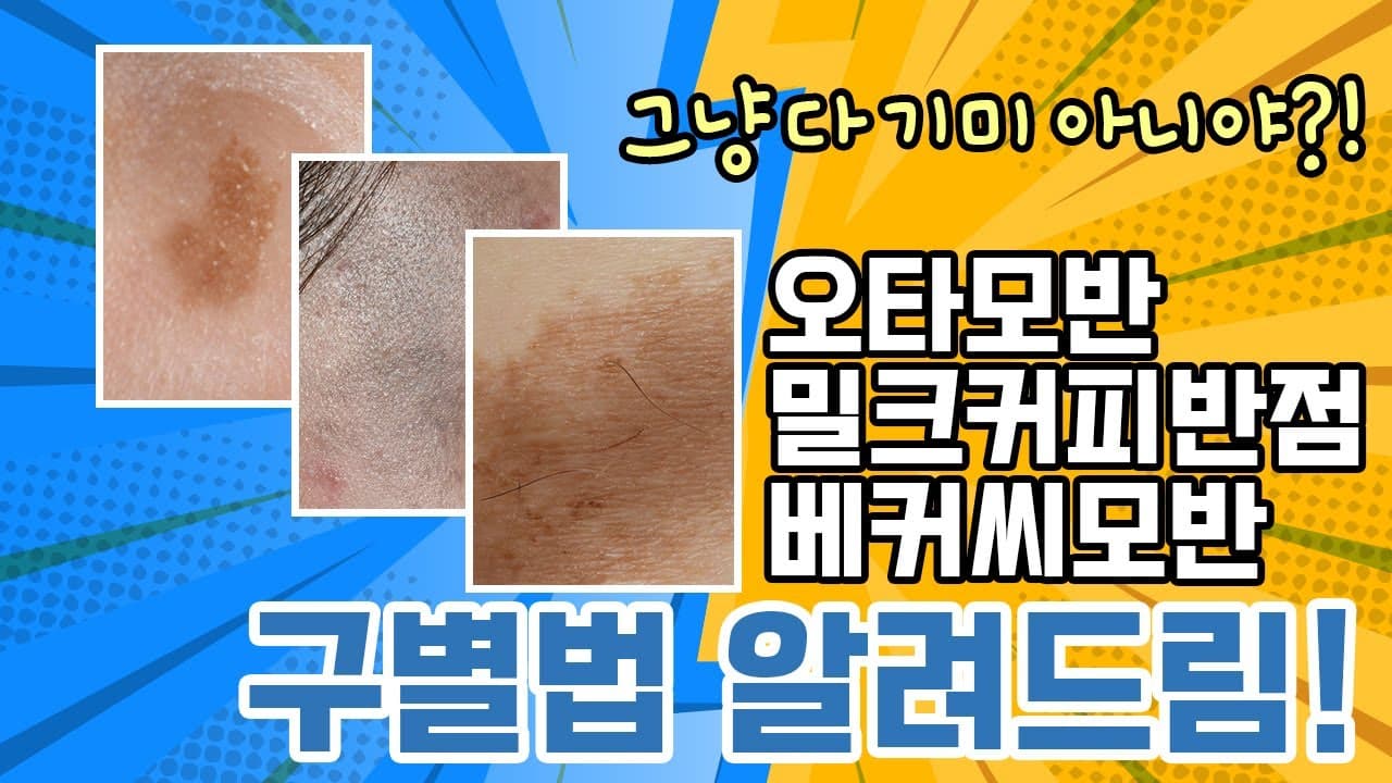 This Isn't Melasma: Distinguishing Nevus Of Ota, Cafe-Au-Lait And Becker's Nevus