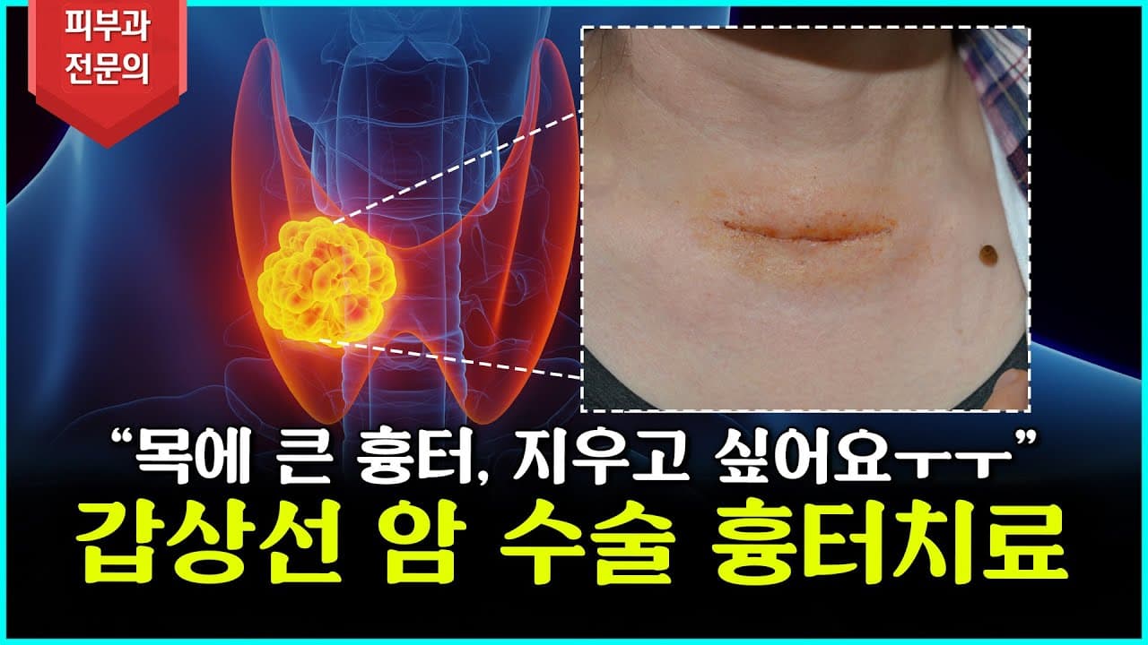 Thyroid Cancer Surgery Scars: Don't Leave Them, Here's Modern Treatment