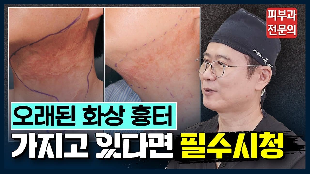 오래된 화상흉터도 레이저로 지울 수 있을까? | 화상흉터 제거 실제 경과