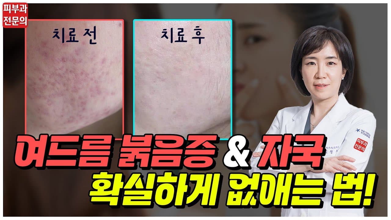⭐전격 공개⭐ 여드름 자국(색소침착) & 붉음증 확실하게 없애는 법