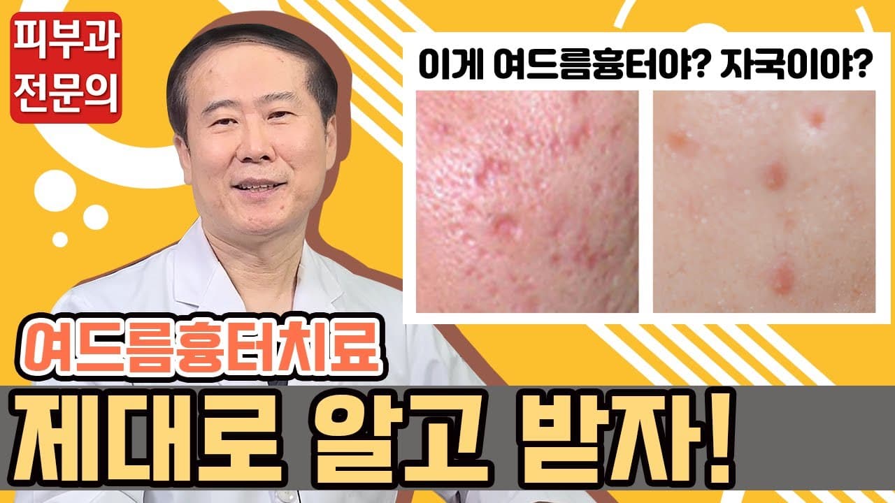 여드름 흉터 치료, 꼭 알아야 할 것들